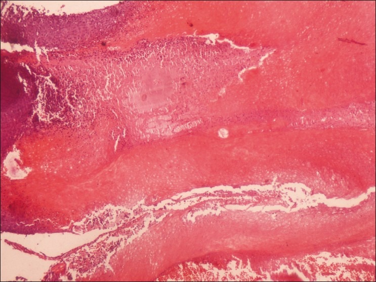 Pilomatricoma forget me not pmc