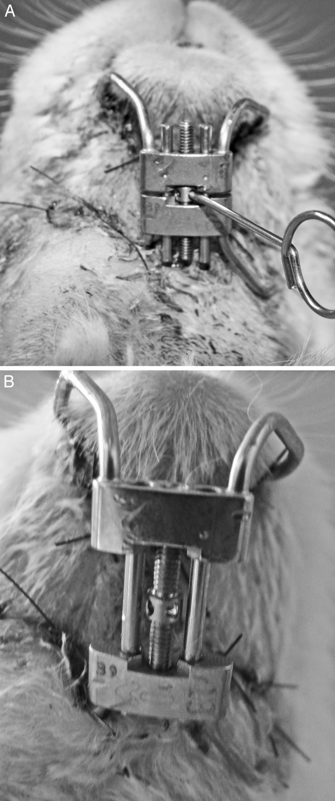 Figure 1. (A) Initial activation of the distraction device; (B) complete opening after the 10th day of activation.