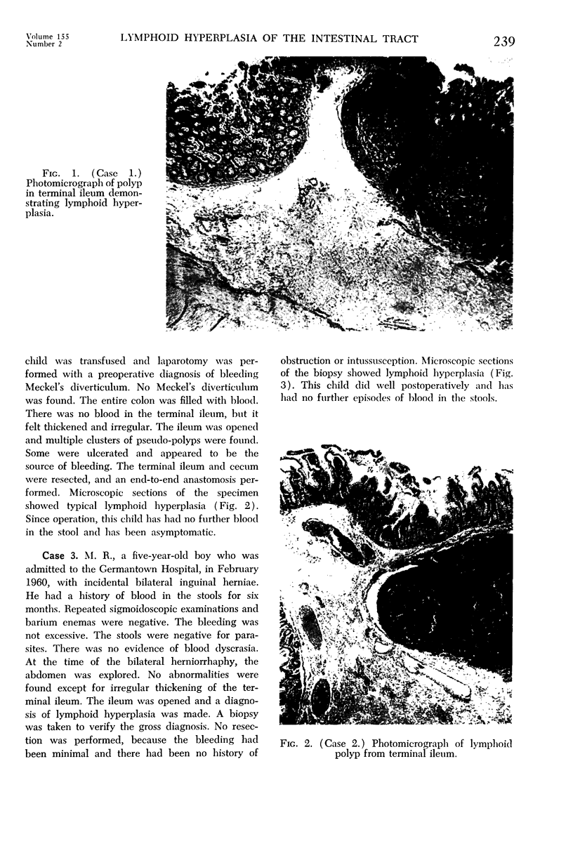 Lymphoid Hyperplasia Of The Intestinal Tract Requiring Surgical