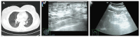 Figure 4. Radiological follow–up imaging of the patient. (A) Chest computed tomography showing no evidence of pulmonary or mediastinal metastasis. (B) Breast ultrasonography revealing postoperative ch...