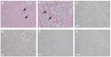 Figure 2. Pathological examination results of the left breast lumpectomy specimen. H&E staining at (A) ×100 magnification (scale bar, 50 µm) and (B) ×400 magnification (scale bar, 20 µm). Black arrows...