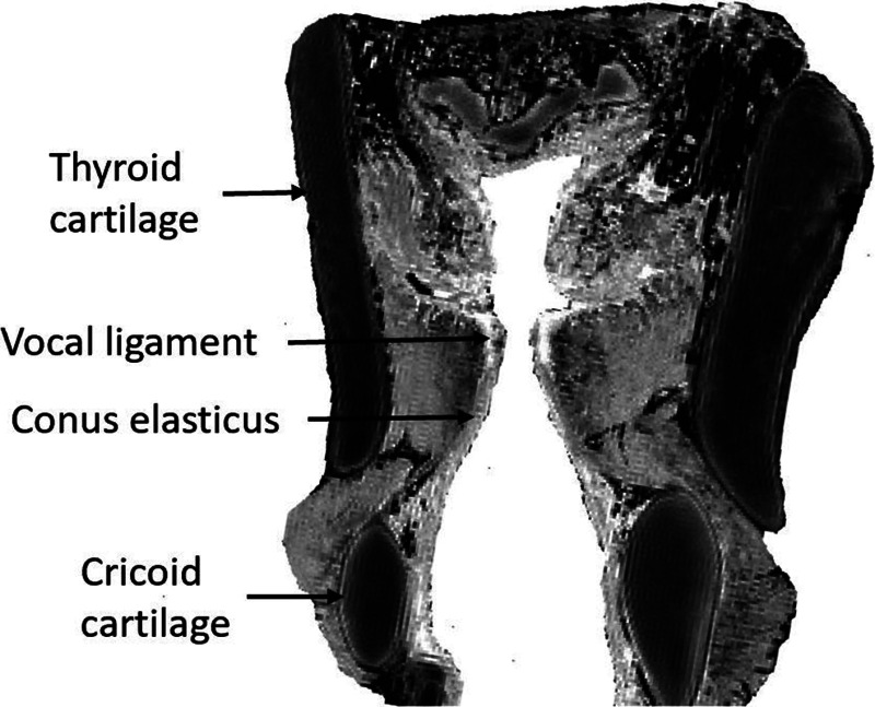 Coronal section of the human larynx