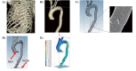 Fig.1.
Quantification of WSS in the aortic arch using CFD modeling on 3D-CT
