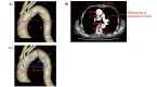 Supplemental Fig.1.
Measurement of CT-derived geometric parameters of the aortic arch of interest