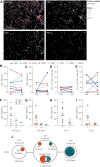 Figure 2. T-cell infiltration in EM and LM lesions. A, A representative tissue section of EM Mel4 is shown using multispectral fluorescent imaging. The overlay image displays combined immunodetection of CD4 (red), CD8 (blue), PD-1 (green), and DAPI (white; top left), whereas individual immunodetections are shown in the remaining panels in black and white images. B–E, Quantification of T-cell infiltrate. The number of cells per mm2 of tissue is represented by dots, with lines connecting the EM and LM lesions of each patient. The average cell numbers are indicated by dashed lines. The quantified data include the number of infiltrating CD4+ T cells (B), number of CD8+ T cells (C), and the percentage of PD-1+ cells among CD4+ (D) and CD8+ T cells (E). The Wilcoxon matched-pairs signed rank test did not reveal significant differences between EM and LM samples for the datasets presented in B–E. F–I, CD4+ (F and H) and CD8+ (G and I) T-cell infiltrate is shown in relation to positive (i.e., scored strongly positive or weak for all 3 markers), intermediate (i.e., at least one marker scored positive and one or two negative or heterogeneous), and a lack of HLA class I expression (F and G), and in relation to positive or negative PD-L1 expression (H and I) as determined by IHC (Table 1). No significant differences were observed using Kruskal–Wallis and Mann–Whitney U tests, respectively. J, The number of unique T-cell receptors is depicted using semi-proportional circles for the indicated samples. The absolute numbers of T-cell receptors are provided below each circle. Orange sub-circles indicate shared clones between the EM-FFPE sample and the ACT product, with the number of shared clones and the corresponding percentage in EM-FFPE and ACT product indicated next to the circles. Green sub-circles represent clones shared between the ACT product and LM-FFPE tissue, along with the associated numbers and percentages present in each of these samples, respectively. The overlapping region in the middle circles indicates the 10 shared clones present in both EM and LM, depicted in white.