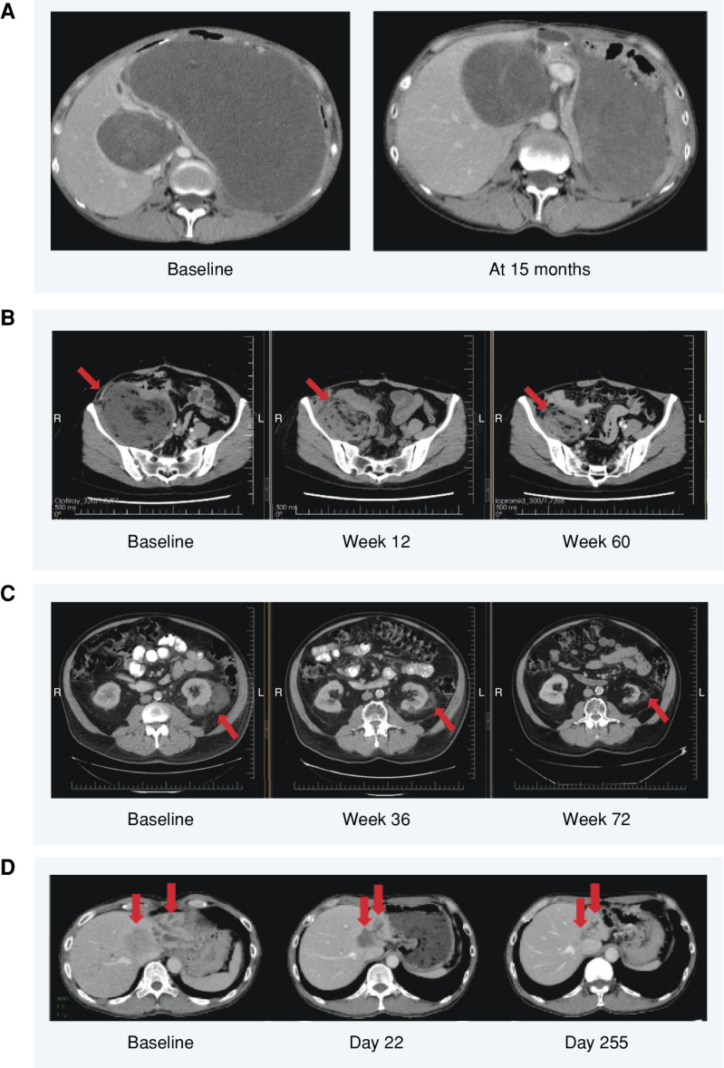 Figure 3. Example patient scans showing responses and sustained disease stabilizations with brigimadlin. A, A 54-year-old female with a retroperitoneal MDM2-amplified WDLPS. The patient was heavily pretreated before being enrolled in the present trial, in which she received brigimadlin 20 mg q3w. The patient experienced a partial response (31% tumor reduction) starting at cycle 2. At cycle 10, the dose was reduced to 10 mg due to grade 2 neutropenia not recovering within 14 days. At cycle 19, a further tumor shrinkage (47% reduction) was observed. At cycle 29, the dose was further reduced to 5 mg due to grade 3 anemia. Treatment was finally discontinued after cycle 33 due to progressive disease. B, A 53-year-old female with a retroperitoneal MDM2-amplified WDLPS first diagnosed in July 2010 who, after four surgical resections, received doxorubicin for 6 cycles starting in March 2020 before progressing and being enrolled to the present trial. The patient received brigimadlin 80 mg D1q3w and experienced a partial response at cycle 3 (32% tumor reduction). The dose was reduced to 60 mg at cycle 4 due to neutropenia, to 50 mg at cycle 5 due to neutropenia, to 45 mg at cycle 8 due to thrombocytopenia, then to 30 mg at cycle 12 (December 2021) due to neutropenia, and finally to 20 mg at cycle 20 due to neutropenia. At data cutoff, the patient was ongoing in the study with a partial response (42% best tumor reduction, more than 25 months on treatment). C, A 65-year-old male with stage IV MDM2-amplified left perirenal DDLPS. Following previous treatment with adriamycin and olaratumab, followed by radiotherapy, the patient received brigimadlin 45 mg q3w. The patient achieved stable disease and stayed on treatment for nearly 2 years before experiencing progressive disease. D, A 51-year-old male with MDM2-amplified cholangiocarcinoma. Following 3 prior lines of therapy, he received brigimadlin 80 mg q3w, which was reduced to 45 mg q3w for 38 days in cycle 2 due to grade 4 thrombocytopenia and grade 4 neutropenia. The patient achieved a partial response by day 22, which was still evident on day 360; maximum tumor shrinkage was −73%. The patient remained on treatment for 13.3 months before experiencing progressive disease. B–D, The red arrows indicate the tumor sites. L, left; R, right.