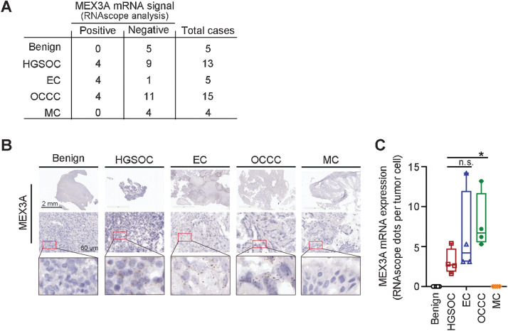 Figure 1. Upregulation of MEX3A is observed in EC and OCCC subtypes, as well as HGSOC. A, Summary table of MEX3A mRNA expression detected using RNAscope analysis in an ovarian cancer cohort. B, Representative images of MEX3A RNAscope using benign and ovarian cancer tumor sections from patients. Red boxes indicate enlarged regions. Scale bars indicate 2 mm or 60 μm as shown in the images. C, Quantification and comparison of MEX3A mRNA (dots) detected by RNAscope in MEX3A-positive HGSOC, EC, and OCCC samples. Significant differences are based on unpaired t test. *, P < 0.05; n.s., not significant.