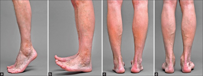 Combined Ipsilateral Fracture Of The Tibial Pilon, Talar Body, And 