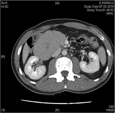 Laparoscopic repair of a right-sided paraduodenal hernia - PMC