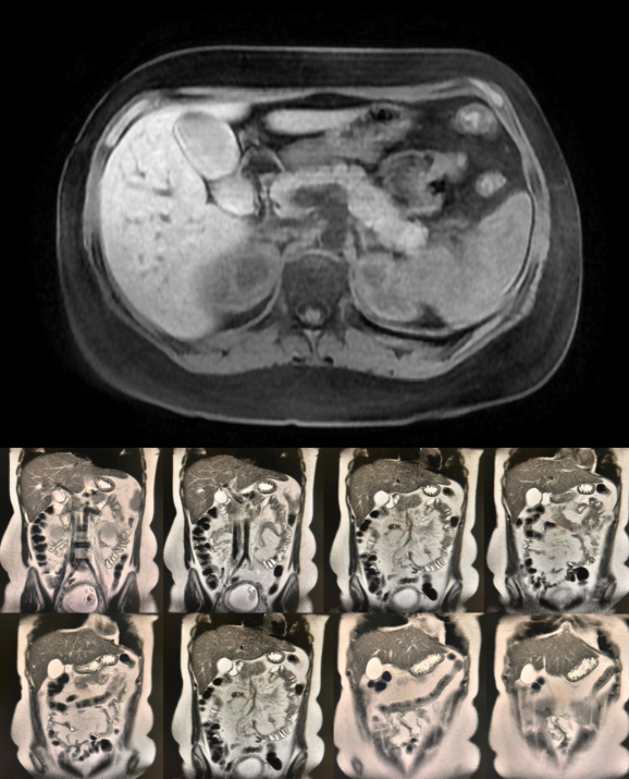 Heterotopic pregnancy and amniotic embolism a case report pmc