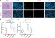 Matrix metalloproteinase (MMP) inhibition (MMPI) decreases
intratumoral MMP9 expression and tumor-associated macrophage (TAM)
infiltration. (A) Representative low-magnification (10×) hematoxylin
and eosin (H&E) images show Tib-75–induced tumors in BALB/c
mice after MMP inhibition with the broad-spectrum inhibitor batimastat
(bottom row) relative to control mice receiving injection with the vehicle
phosphate-buffered saline (PBS) (top row). L = healthy liver, T = tumor.
Representative images of immunofluorescence costaining of intratumoral MMP9
expression and infiltration of TAMs (CD206+). Magnification, 20×.
DAPI = 4',6-diamidino-2-phenylindole. (B, C) Box and whisker plots
show quantification of intratumoral (B) MMP9-expressing cells and (C) CD206+
cells in Tib-75 induced–hepatocellular carcinomas. A decrease in
intratumoral MMP9+ cells and CD206+ cell infiltration is seen in mice
treated with the MMP inhibitor (n = 6) relative to phosphate-buffered
saline–treated control mice (n = 6 per group) and in mice treated
with incomplete cryoablation (iCryo) and the MMP inhibitor (n = 6) versus
mice treated with incomplete cryoablation and phosphate-buffered saline (n =
6). Whiskers indicate maximum and minimum values. Boxes extend from the 25th
to 75th percentiles. The line in the middle of each box is plotted at the
median. * = P < .05 and *** = P <
.001, according to a Kruskal-Wallis test with Dunn correction for multiple
comparisons. FOV = field of view.