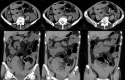 CT scans showing abdominal cross-sections at different levels. The top row displays transverse slices, revealing various organs and structures. The bottom row shows coronal sections, highlighting the arrangement of internal organs and fluid or gas pockets.
