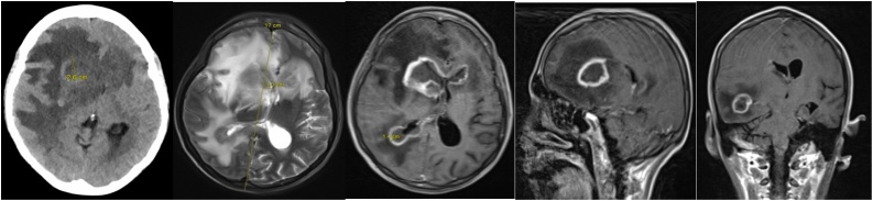 Diagnosis of primary CNS lymphoma in a HIV patient with multiple ring ...