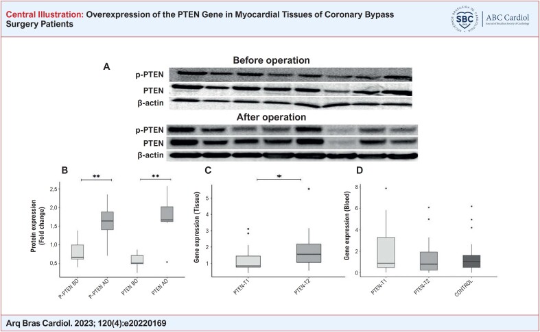 Gene expression and western blot results of the patients with CAD. Membrane images of PTEN and P-PTEN protein levels determined using specific antibodies in myocardial tissues of female/male patients (A). PTEN and P-PTEN protein expression findings in myocardial tissue taken from patients before and after surgery. β-actin was used as a loading control (B). The expression of the PTEN gene was determined by quantitative real-time PCR (qRT-PCR) in myocardial tissues taken from patients at 2 different times (C). Expression of the PTEN gene was determined by quantitative real-time PCR (qRT-PCR) in blood samples taken from patients at 2 different times and in control blood samples (D). Comparisons: P-PTEN BO vs. P-PTEN AO, PTEN BO vs. PTEN AO, and PTEN-T1 vs. PTEN-T2 (in blood and tissue samples separately) via Wilcoxon Signed Rand test; PTEN-T1 vs. Control and PTEN-T2 vs. Control via Mann-Whitney U test (*p<0.05, **p<0.001). (T1: before cardiopulmonary bypass, T2: after cardiopulmonary bypass).