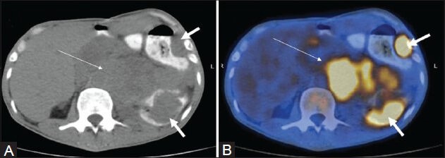 Figure 11 (A, B)