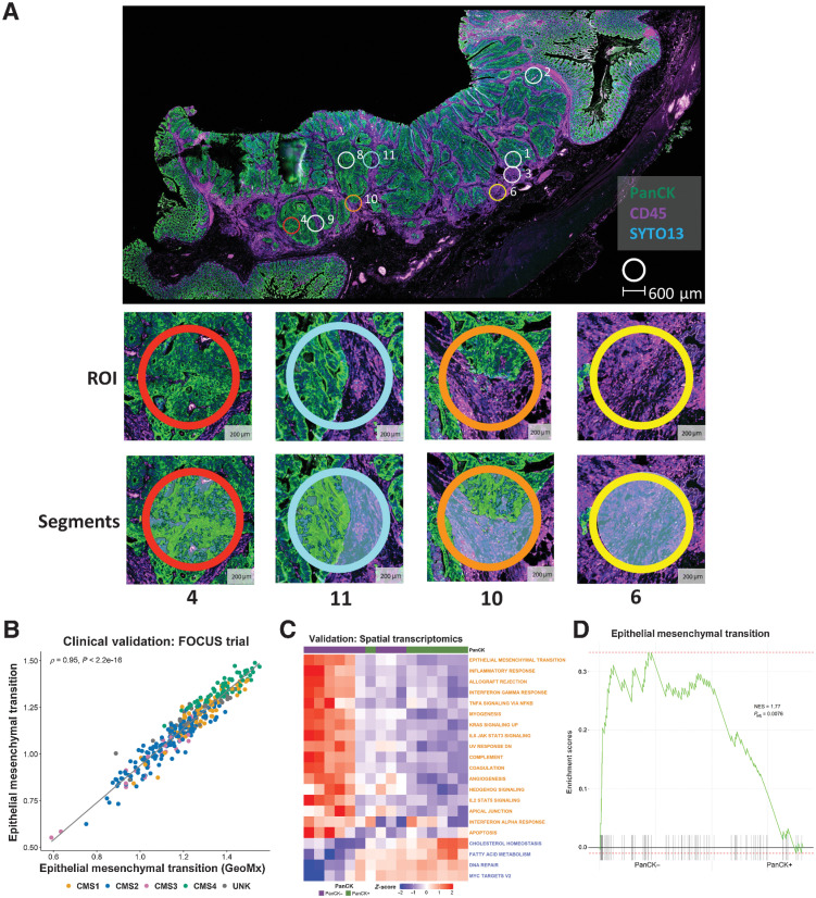 Figure 6. Spatial transcriptomic confirms the confounding effects of the stroma. A, Whole slide image of colon cancer case selected for spatial transcriptomic analysis. The tissue was stained with PanCK and CD45 with PanCK+ regions (green) identifying epithelium and CD45+ regions (purple) identifying immune components. Small circles indicate the ROIs selected for spatial transcriptomic analysis; ROI 4: high epithelial content, ROI 11: mixed epithelial content, ROI 10 demonstrates a ROI with low epithelial content, ROI 6: no epithelial content. B, Scatterplot showing the correlation between ssGSEA scores for the full Hallmark Epithelial Mesenchymal Transition gene set (n = 200 genes) and the corresponding reduced GeoMx Epithelial Mesenchymal Transition gene set (n = 81 genes) in the FOCUS clinical trial cohort (Spearman rho = 0.95). Samples colored by CMS calls (CMS1: n = 62; CMS2: n = 155; CMS3: n = 29; CMS4: n = 66; UNK: n = 44). C, Heatmap of ssGSEA scores for the Hallmark gene sets for the PanCK+ (epithelium; n = 8) and PanCK- (stroma; n = 11) areas within the regions of interest. Only the Hallmark gene sets identified as significantly and concordantly enriched in stroma or epithelium in both the LCM discovery and LCM validation cohorts are shown (the GeoMx versions of these Hallmark gene sets were used). D, GSEA comparing PanCK- areas (stroma; n = 11) to PanCK+ areas (epithelium; n = 8) for the Hallmark Epithelial Mesenchymal Transition gene set (GeoMx version). NES, normalized enrichment scale.