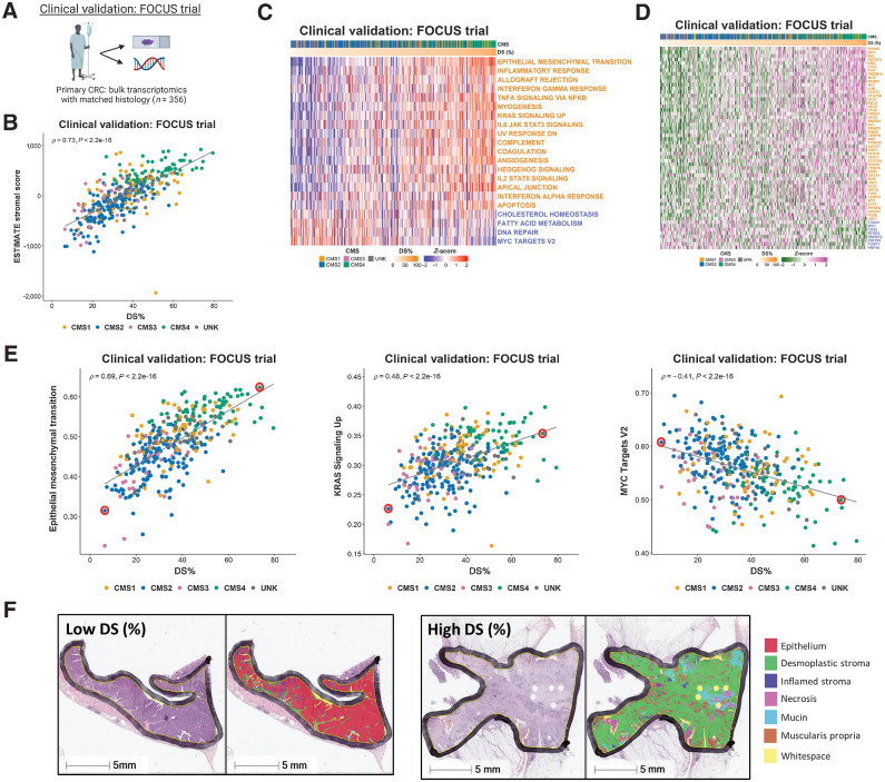 Figure 4. Application of findings to bulk colorectal cancer tumor data. A, Schematic summary of the clinical validation dataset from the FOCUS clinical trial. B, Scatterplot showing correlation between desmoplastic stroma percentage determined from H&E assessment and ESTIMATE Stromal Score determined by transcriptomic data in the FOCUS clinical trial samples (Spearman rho = 0.73, P < 2.2e-16), colored by CMS calls (CMS1: n = 62; CMS2: n = 155; CMS3: n = 29; CMS4: n = 66; UNK: n = 44). C, Heatmap of ssGSEA scores for the Hallmark gene sets (identified in Fig. 2 as significantly enriched in the stroma/epithelium in the LCM discovery and validation cohorts) for the FOCUS clinical trial samples. Samples ranked in order of DS% from lowest (left) to highest (right). Gene sets with names colored orange were significantly enriched in stroma in the LCM discovery and LCM validation cohorts and gene sets with names colored blue were significantly enriched in epithelium in the LCM discovery and LCM validation cohorts. D, Heatmap of activity scores for TFs (identified as significantly enriched in the stroma/epithelium in the LCM discovery and validation cohorts) for the FOCUS clinical trial samples. Samples are arranged in order of DS% from lowest (left) to highest (right). Gene sets with names colored orange were significantly enriched in stroma in the LCM discovery and LCM validation cohorts and gene sets with names colored blue were significantly enriched in epithelium in the LCM discovery and LCM validation cohorts. E, Scatterplots showing the correlation between desmoplastic stroma percentage determined from H&E and ssGSEA scores for the Epithelial Mesenchymal Transition (left; Spearman rho = 0.69, P < 2.2e-16), KRAS Signaling Up (middle; Spearman rho = 0.48, P < 2.2e-16) and MYC Targets V2 (right; Spearman rho = -0.41, P < 2.2e-16) Hallmark gene sets. We identified two cases representative of low and high DS% in each of these analyses (red circles). F, H&E along with HALO mark-up for the representative low and high desmoplastic stromal percentage samples identified in (E). CRC, colorectal cancer.