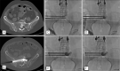 Example of prophylactic fixation by internal cemented screw (FICS) by using the anchorage technique. Images in a 51-year-old woman with metastatic renal cancer who underwent radiation therapy 9 days prior to fixation by FICS. A, Preprocedural axial noncontrast CT image shows a 51-mm–wide osteolytic sacral metastasis with extensive cortical disruption. B, Postprocedural axial noncontrast CT image shows one of the transsacroiliac screws with anchorage cement at the tip. FICS steps: C, Insertion of two 8-gauge needles by the right transsacroiliac track; D, injection of polymethyl methacrylate cement through the needles; E, exchange of the needles over Kirschner wires and insertion of two 8-mm and 10-cm screws; and, F, withdrawal of the wires and final result.