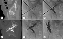 Example of prophylactic fixation by internal cemented screw (FICS) by using both anchorage and consolidation techniques. Images in a 63-year-old woman with multiple myeloma who underwent radiation therapy 2 months prior to FICS. A, Preprocedural sagittal noncontrast CT image shows a 63-mm–wide osteolytic tumor of the acetabulum involving the superior acetabular wall. B, Postprocedural sagittal noncontrast CT image shows the anterior transiliac screw and additional cement for consolidation FICS steps: C, insertion of two 8-gauge needles by the ascending and descending anterior transiliac tracks; D, injection of polymethyl methacrylate cement through the needles; E, insertion of one 8-mm and 11.5-cm screw through the ascending transiliac track; and, F, final result from a straight frontal view.