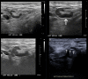 In a 46-year-old patient with a strong family history of breast cancer,
(A) a screening US prior to COVID-19 vaccination demonstrated a morphologically
normal left axillary lymph node. (B) Twenty-five days following the second dose
of the COVID-19 vaccine, the patient presented with a palpable lump in the left
axilla and US demonstrated enlarged lymph nodes with cortex measuring up to 6 mm
in thickness (arrow). (C) Follow-up US 21 weeks following demonstrated stable
axillary lymphadenopathy. (D) A US-guided core biopsy was then recommended and
pathologic analysis demonstrated lymphoid cells negative for carcinoma. Arrows
indicate the path of the needle.