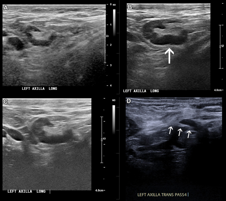 In a 46-year-old patient with a strong family history of breast cancer, (A) a screening US prior to COVID-19 vaccination demonstrated a morphologically normal left axillary lymph node. (B) Twenty-five days following the second dose of the COVID-19 vaccine, the patient presented with a palpable lump in the left axilla and US demonstrated enlarged lymph nodes with cortex measuring up to 6 mm in thickness (arrow). (C) Follow-up US 21 weeks following demonstrated stable axillary lymphadenopathy. (D) A US-guided core biopsy was then recommended and pathologic analysis demonstrated lymphoid cells negative for carcinoma. Arrows indicate the path of the needle.