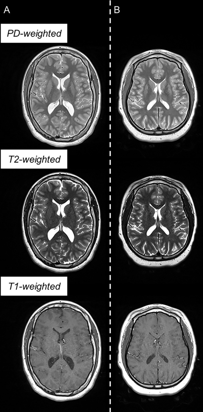 Example triple turbo spin-echo brain MRI scans in (A) neurotypically developing and (B) atypically developing extremely preterm–born adolescents. Proton density (PD)–weighted, T2-weighted, and T1-weighted images are provided. MRI scans in the atypically developing participant (full-scale intelligence quotient <85) demonstrated qualitatively smaller white and gray matter volumes and nearly indistinguishable tissue contrast compared with the neurotypically developing participant.