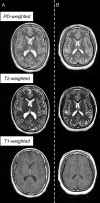 Example triple turbo spin-echo brain MRI scans in (A) neurotypically
developing and (B) atypically developing extremely preterm–born
adolescents. Proton density (PD)–weighted, T2-weighted, and
T1-weighted images are provided. MRI scans in the atypically developing
participant (full-scale intelligence quotient <85) demonstrated
qualitatively smaller white and gray matter volumes and nearly
indistinguishable tissue contrast compared with the neurotypically
developing participant.