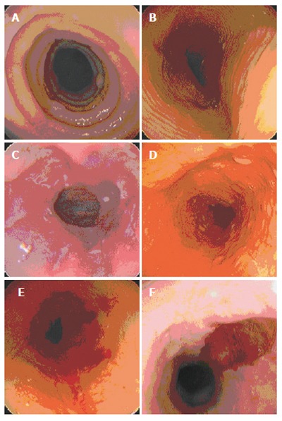 Eosinophilic esophagitis: A newly established cause of dysphagia - PMC