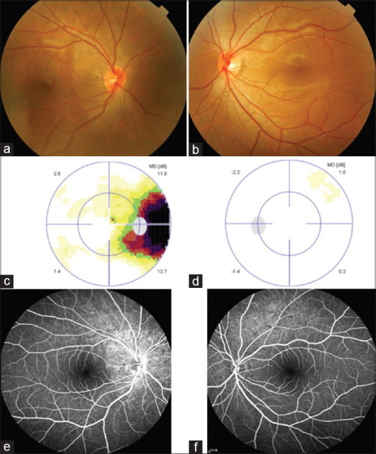 Acute zonal occult outer retinopathy presenting as optic neuritis - PMC