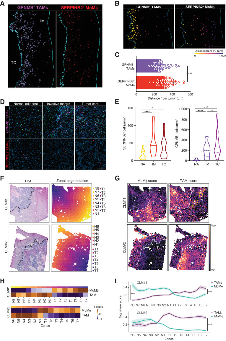 Figure 4. Spatial assessment of MoMϕ and TAMs in the TME. A–E, Distribution of SERPINB2+ MoMϕ and GPNMB+ TAMs in NA, IM, and TC areas and distance to tumor analysis in a restrospective CLM cohort by mf-IHC. A, mf-IHC images showing the distribution of rendered GPNMB+CD68+ and SERPINB2+ cells in the IM of CLM specimens. Representative picture of n = 48 slides stained. Scale bar: 400 μm. B, Representative images showing the different distribution of rendered GPNMB+CD68+ (top) and SERPINB2+ cell annotations (bottom) in the IM. Cells are colored according to distance from the TC. Scale bar: 300 μm. C, Quantification of the average distance of SERPINB2+ and GPNMB+CD68+ cells from TC. Each dot represents a patient (n = 48). ****, P < 0.0001 by paired t test. D, Representative images of GPNMB+ and SERPINB2+ Mϕ in the NA, IM and TC regions of human CLM. n = 20. E, Violin plots showing the number of SERPINB2+ and GPNMB+CD68+ in the NA, IM and TC. Dashed lines represent median; dotted lines represent quartiles. n = 20; *, P < 0.05; ****, P < 0.0001 by paired t test. (F–I) Spatial assessment of SERPINB2+ MoMϕ and GPNMB+ TAMs by spatial transcriptomics analysis on FFPE CLM samples (n = 2). F, H&E staining of CLM samples analyzed by Visium spatial transcriptomics (left) and tissue segmentation of tumor and normal regions in parallel contiguous zones from the tumor-adjacent liver interface (dashed line; right). Scale bars: 1 mm. G, Spatial feature plots showing signature score for MoMϕ (right) and TAMs (left). White line shows tumor-adjacent liver interface; blue line shows MoMϕ score enrichment in proximity of blood vessels; yellow lines show TAM score enrichment in proximity of bile ducts. H, Heat map showing the z-score of the average expression for each zone of MoMϕ and TAM signature along the adjacent liver (N1–N8) and tumor regions (T1–T7). I, Line plot of MoMϕ (green line) and TAM (purple line) average signature expression along the adjacent liver and tumor regions (N1–N8, T1–T7). ****, P < 0.0001 by one-sided Wilcoxon rank sum test.