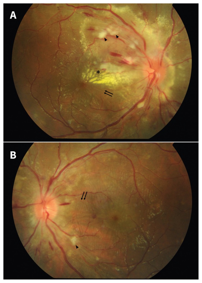 Hypertensive Retinopathy And Choroidopathy - Pmc