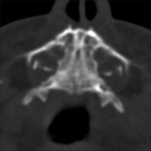 Congenital nasal pyriform aperture stenosis: A rare cause of nasal ...