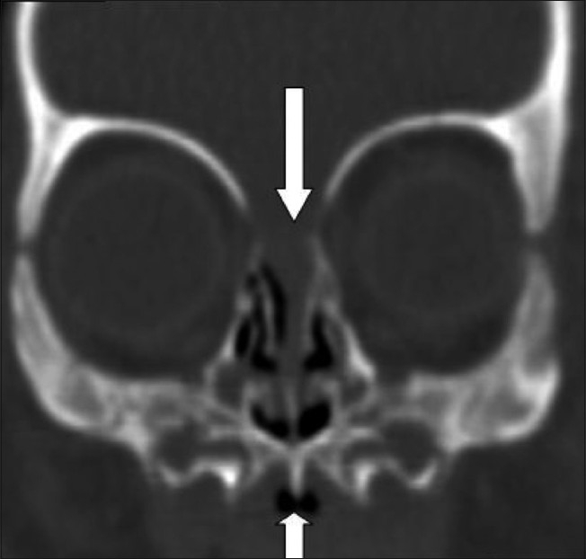 Congenital nasal pyriform aperture stenosis: A rare cause of nasal ...