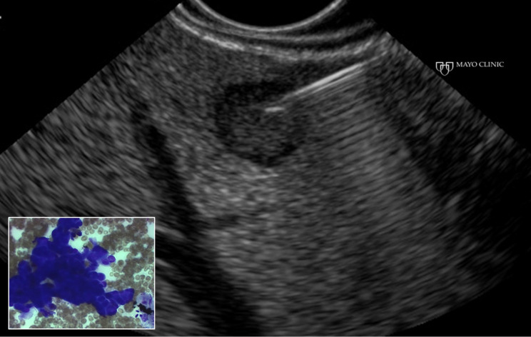 Endoscopic Ultrasound In Chronic Liver Disease Pmc