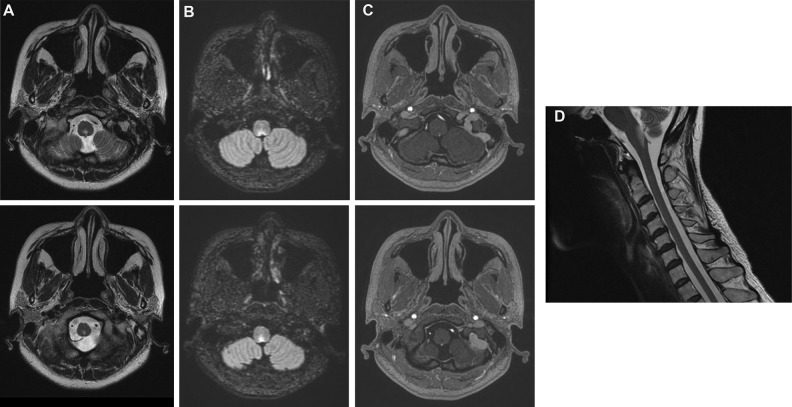 Area Postrema Syndrome - PMC