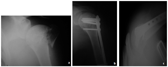 Fig. 1: 24-year-old male with Neer 3-part fracture, presentation in 2010; preoperative radiograph (Panel a) and postoperative
radiographs (Panels b and c).