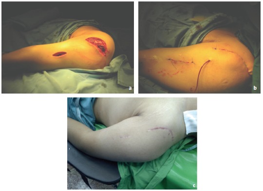 Fig. 3: Incisions made in anterolateral approach during operation (Panel a), postoperatively (Panel b) and during follow-up (Panel c).