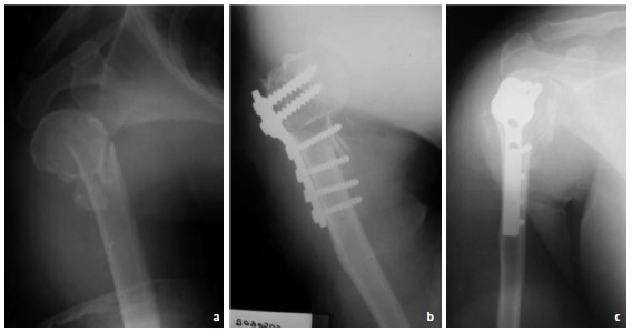 Fig. 2: Female, 65-year-old with Neer 3-part fracture, presented in 2003; preoperative radiograph (Panel a), postoperative radiographs (Panel b) and 2 years after the operation (Panel c).