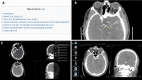 Screenshots of the proposed call platform show user interface for a
specific condition (basilar thrombus at CT angiography). (A) Each
condition-specific page includes an interactive table of contents that
serves as the framework for organizing content. (B) There are annotated
still images integrated within the resource; for example, this axial CT
angiogram highlights the basilar artery containing a thrombus (yellow arrow)
and a portion that opacifies appropriately (white arrow). (C) Each page has
an embedded YouTube video playlist that includes a search pattern video and
dedicated case review of multiple cases to reinforce key teaching points.
(D) Each page also links to an online picture archiving and communication
system (PACS) server where fully interactive cases are provided, including
all cases reviewed in the video playlist.
