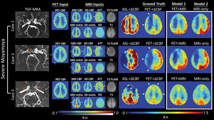 Representative images in three patients with severe Moyamoya disease with impaired relative cerebral blood flow (CBF) change (rΔCBF) measured with PET. Upper row: Case 1 shows a 43-year-old woman with moderate right M1 stenosis (arrow). Baseline CBF is preserved, while arterial transit time (ATT) is prolonged (*), in right cerebral hemisphere. Both PET-plus-MRI and MRI-only models correctly predict impaired rΔCBF in right cerebral hemisphere, while rΔCBF measured with multidelay (MD) arterial spin labeling (ASL) (ASL rΔCBF) mistakenly shows lower rΔCBF in left side. Middle row: Case 2 shows 18-year-old woman with occluded right distal internal carotid artery (double arrows). In addition to prolonged baseline ATT (*), reduced baseline PET-CBF, ASL CBF, and mean ASL difference signal (mASL) (open arrowheads) are noted in right cerebral hemisphere, as well as a chronic infarct on T2 fluid-attenuated inversion-recovery (FLAIR) (open arrow). Both deep learning models correctly predicted more severely impaired rΔCBF than in case 1. Lower row: Case 3 shows a 33-year-old woman with bilateral M1 occlusion (double arrows). Both models successfully predicted impaired rΔCBF from inputs of prolonged baseline ATT (*) and mildly reduced MD-mASL bilaterally (open arrowheads), PD = proton density–weighted image, PET-rΔCBF = relative CBF change measured with PET, SD = single-delay, TOF-MRA = time-of-flight MR angiography.