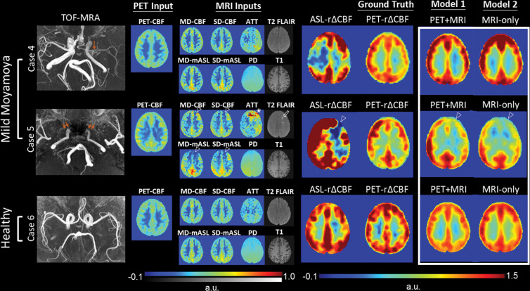 Representative images in two patients with mild Moyamoya disease without impaired relative cerebral blood flow (CBF) change (rΔCBF) by using PET and a healthy control participant. Upper row: Case 4 shows a 29-year-old woman with mild left M1 stenosis (arrow). Both models successfully predict preserved rΔCBF in bilateral hemispheres, while rΔCBF measured with multidelay (MD) arterial spin labeling (ASL) (ASL rΔCBF) shows unexpected focal defect at right frontoparietal region. Middle row: Case 5 shows a 46-year-old man with bilateral internal carotid artery occlusion (double arrows) after bilateral bypass surgery. Baseline PET-CBF was preserved, but focal defects in CBF and mean ASL difference signal (mASL) of both ASLs, arterial transit artifact in MD-mASL CBF map (open arrowhead), prolonged arterial transit time (ATT) (*), and old infarct (open arrow) were observed in left anterior frontal region. Both models mistakenly predicted impaired rΔCBF in left anterior cerebral artery territory, probably due to previous bypass surgery. Lower row: Case 6 shows 28-year-old male healthy control participant with normal rΔCBF measured with PET (PET-rΔCBF). PD = proton density–weighted image, SD = single-delay, TOF-MRA = time-of-flight MR angiography.