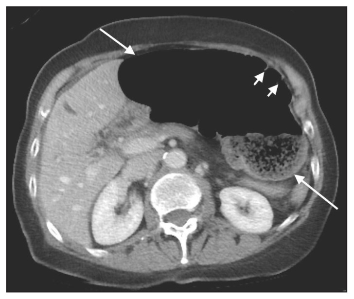 Melanosis Coli: A Case of Mistaken Identity—A Case Report - PMC