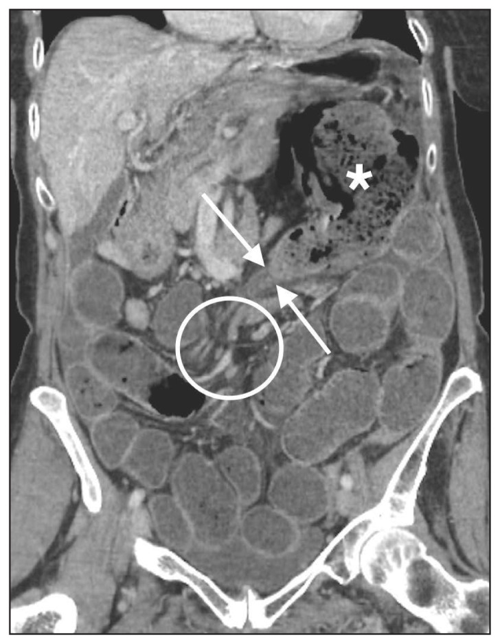 Melanosis Coli: A Case of Mistaken Identity—A Case Report - PMC