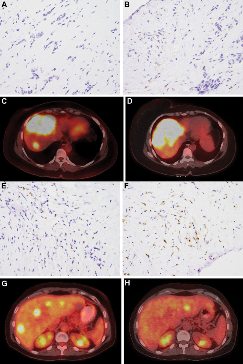 A 47-year-old woman with metastatic breast cancer underwent transarterial radioembolization (TARE), with the first treatment to the right lobe of the liver. Pre-TARE baseline biopsy specimens show (A) low programmed cell death protein (PD) 1 staining (DAB brown) and (B) low CD4 staining (brown) (magnification, ×400). PET/CT images (C) before and (D) after TARE demonstrate progressive disease A 51-year-old woman with metastatic breast cancer underwent TARE, with the first treatment to the right lobe of the liver. Pre-TARE baseline biopsy specimens show (E) high PD-1 staining and (F) high CD4 staining (magnification, ×400). PET/CT images (G) before and (H) after TARE demonstrate complete response.