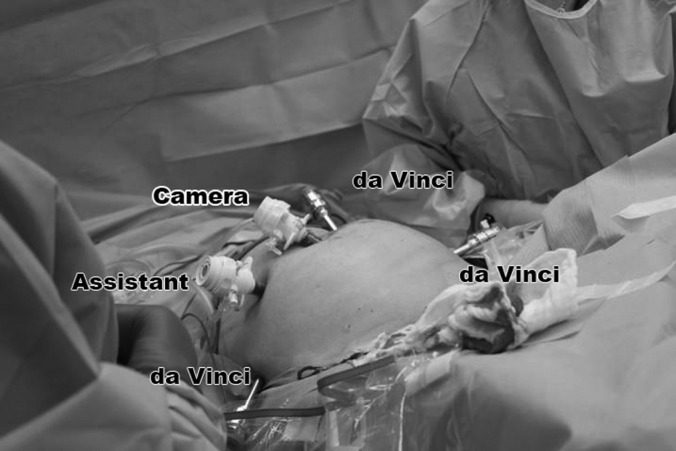 Vaginal Cuff Dehiscence in Robotic-Assisted Total Hysterectomy - PMC