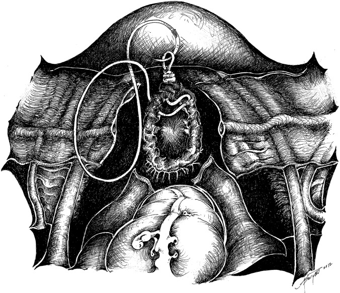 Vaginal Cuff Dehiscence in Robotic-Assisted Total Hysterectomy - PMC