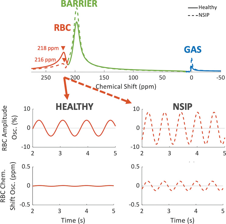 Graphs of xenon 129 MR spectroscopy results in participant with nonspecific interstitial pneumonia (NSIP) (woman, age 67 years; dashed orange line) and healthy control participant (man, age 63 years; solid orange line). Difference in red blood cell (RBC) and barrier peaks leading to reduced RBC-to-barrier ratio is clearly visible in participant with NSIP. Also note reduced chemical (Chem.) shift in RBC peak and increased RBC amplitude and chemical shift oscillations (Osc.) associated with cardiac cycle in participant with NSIP.