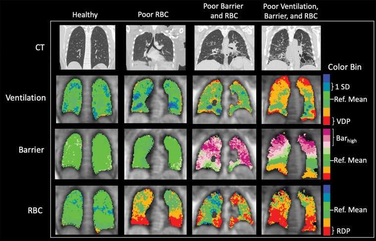 Representative CT scans, xenon 129 (129Xe) MRI ventilation scans, barrier scans, and red blood cell (RBC) scans in healthy control participant and three participants with nonspecific interstitial pneumonia (NSIP) and range of findings (from left to right: man, age 24 years; woman, age 46 years; woman, age 55 years; and woman, age 57 years). Orange and red indicate reduced signal in ventilation and RBC components, indicating abnormalities. Purple indicates increased signal in barrier component, possibly indicating thickened barrier and/or fibrosis. The first and third scans in participants with NSIP (second and fourth columns in figure) show common pattern of basilar-predominant RBC transfer defects. Note that although these RBC transfer defects are ubiquitous features in participants with NSIP, some participants with NSIP have preserved, normal-looking barrier uptake and/or ventilation. Regional correspondence is visible between CT and 129Xe MRI abnormalities. Notably, regions of high barrier measured using 129Xe MRI are also associated with normal CT findings, suggesting early-stage microstructural disease activity not yet visible on CT scan. Barhigh = high barrier percentage, Ref. = reference, RDP = red blood cell defect percentage, SD = standard deviation, VDP = ventilation defect percentage.