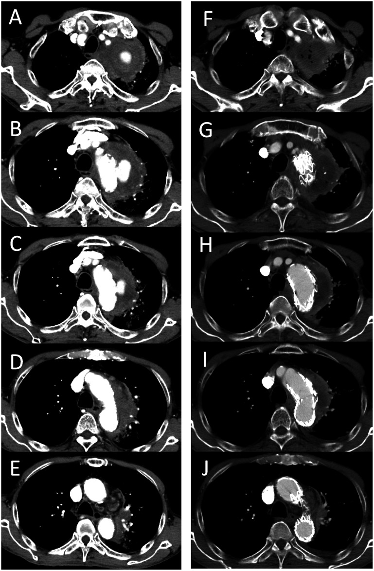 Fig. 1 Computed tomography series before and after thoracic endovascular aortic repair (TEVAR) for the ruptured mycotic aortic aneurysm.