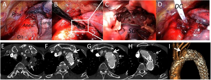 Fig. 2 Video-assisted thoracoscopic debridement for delayed abscess after thoracic endovascular aortic repair.